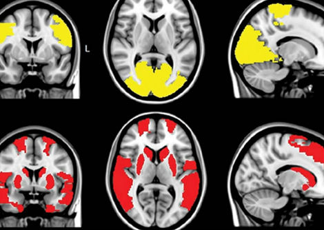 اكتشاف الروابط الدماغية المفقودة التي قد تكون وراء التسبب بالهلوسة عند مصابي مرض باركنسون