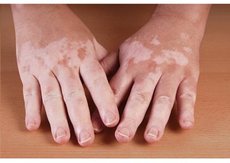 دهون (كريم) قد يعيد تصبّغ الجلد لدى المصابين بالبهاق (Vitiligo)