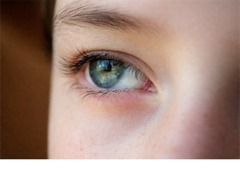 فيروس عقدي بحري (CMNV) كعامل مسبب محتمل لمرض عيني لدى البشر