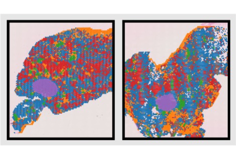  أطلس تاريخي يكشف كيف يؤثر تقدم أنسجة الثدي في السن على خطر الإصابة بسرطان الثدي