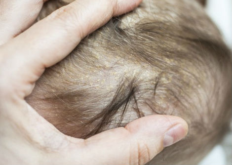 لماذا يمتلك الأطفال مناطق ليّنة في الرأس؟